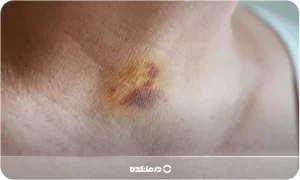 کبودی گردن؛ علت، عوارض + ۵ ژل و پماد برای رفع کبودی فوری
