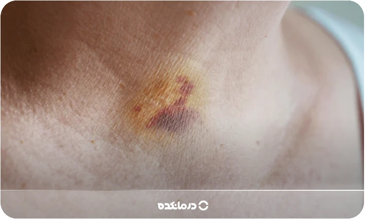 کبودی گردن؛ علت، عوارض + ۵ ژل و پماد برای رفع کبودی فوری