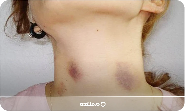 تصویر کبودی گردن را می بینید