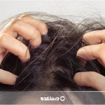 خارش پوست سر؛ ۱۸ علت [درمان‌ دارویی + ۱۱ درمان خانگی]