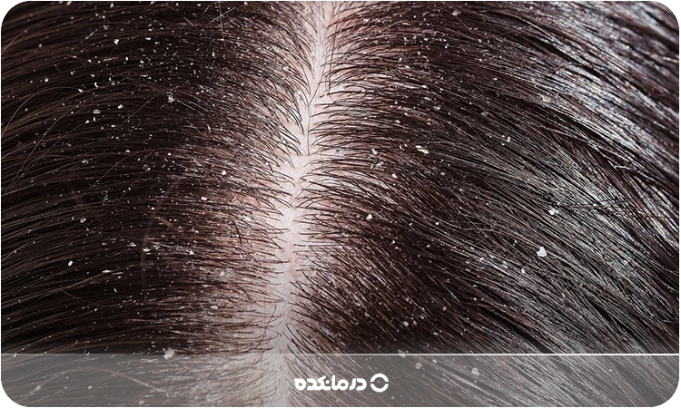 تصویر شوره سر را می‌بینید.