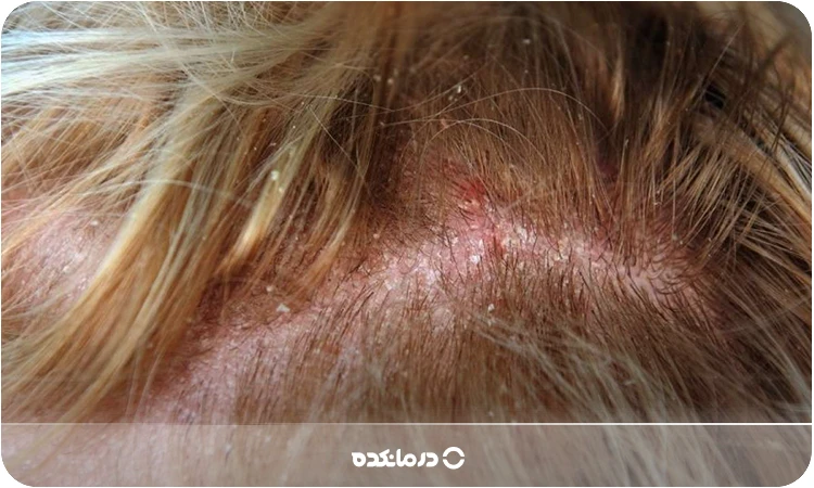 عفونت قارچی پوست سر را می‌بینید.

