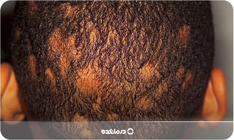 عفونت کرم حلقوی پوست سر را می بینید
