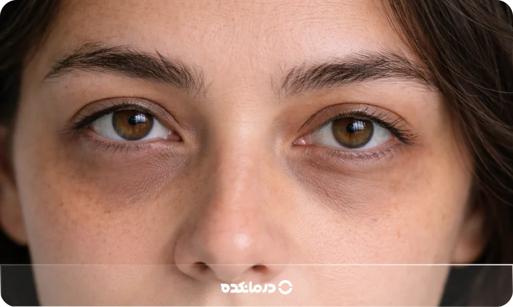 تصویر تیرگی دور چشم قهوه‌ای تیره را می‌بینید.