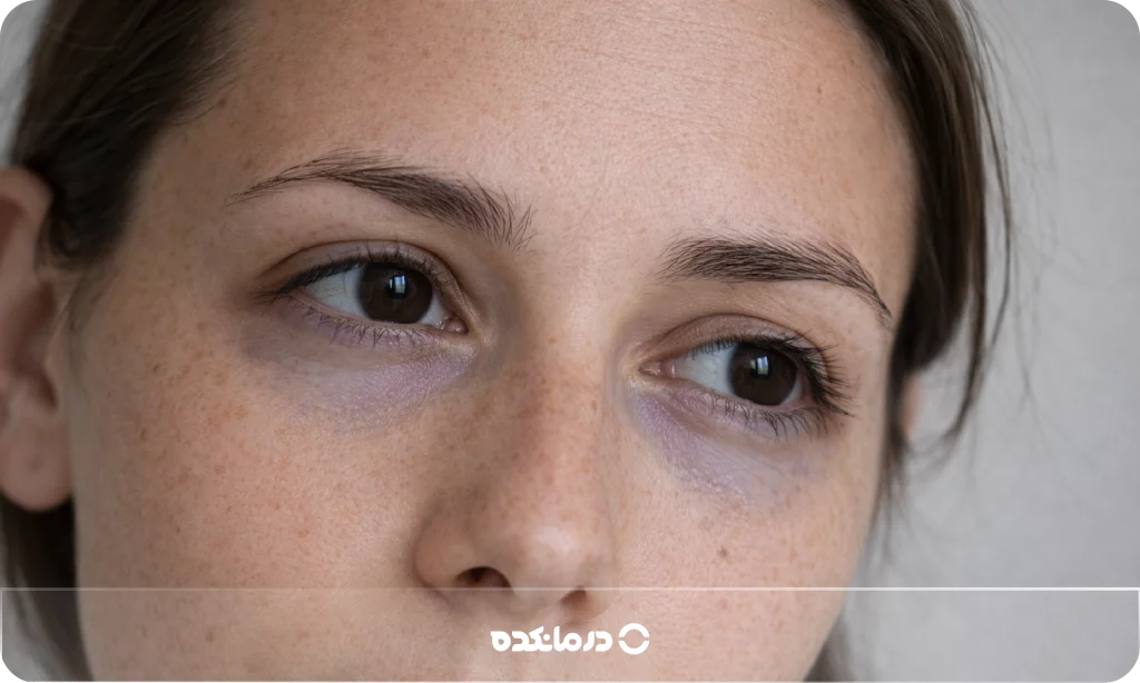 تصویر تیرگی دور چشم آبی یا بنفش را می‌بینید.