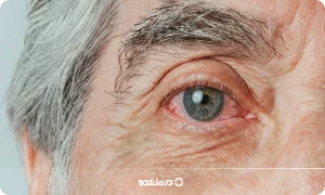 فشار چشم چیست؟ [علائم و تشخیص + عوارض فشار چشم بالا]