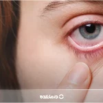 سرطان چشم چیست؟ [علائم، انواع و تصاویر + ۷ روش درمان]
