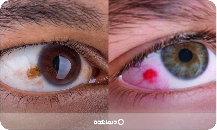 تصویر واقعی از سرطان چشم را می بینید