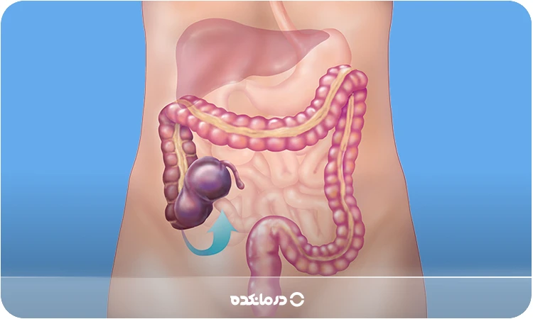 تصویر پیچ خوردگی روده (روده بزرگ)