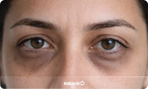 رفع تیرگی دور چشم در سه روز در خانه [۱۲ روش واقعی]