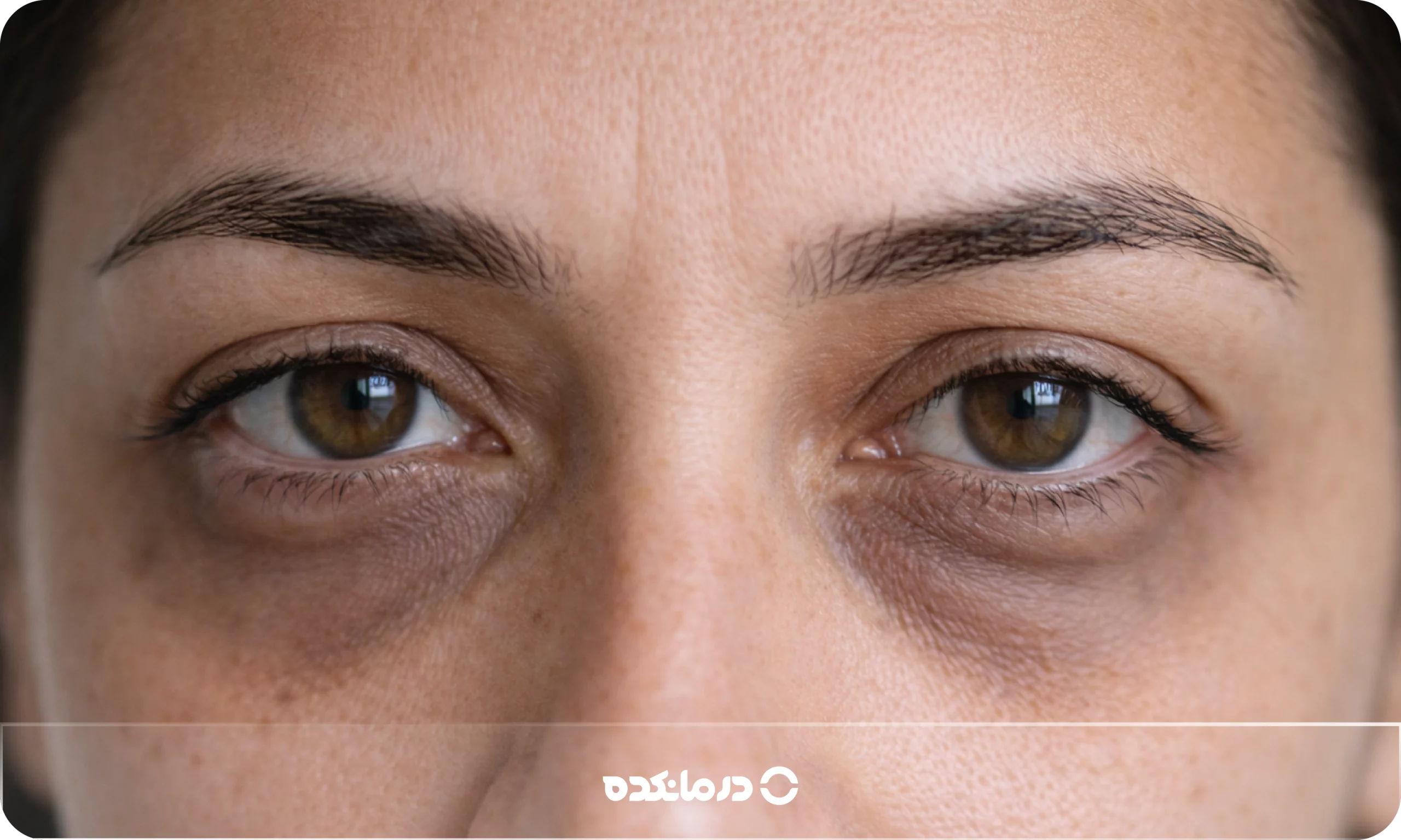 رفع تیرگی دور چشم در سه روز در خانه [۱۲ روش واقعی]