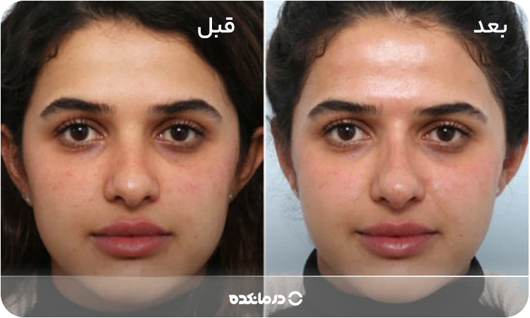 آلترنیتیو: تصویری از قبل و بعد تزریق آنزیم بینی