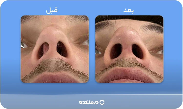 آلت: تصویر قبل و بعد از عمل پولیپ بینی کنار هم