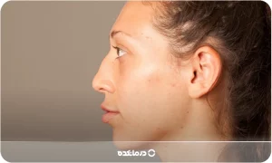 قوز بینی [۵ علت ایجاد، انواع + ۳ روش از بین بردن آن]