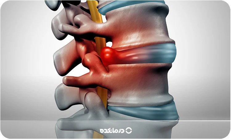 عکس پارگی دیسک کمر را می بینید