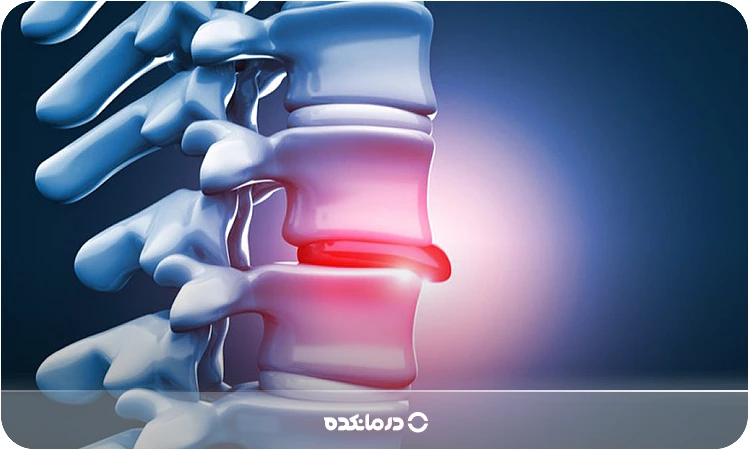تصویری از پارگی دیسک و بیرون زدگی دیسک را می بینید
