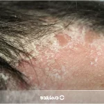 پسوریازیس سر چیست؟ [۶ علائم، علت، انواع + ۷ عکس واقعی]