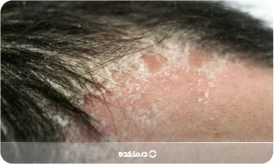 پسوریازیس سر چیست؟ [۶ علائم، علت، انواع + ۷ عکس واقعی]