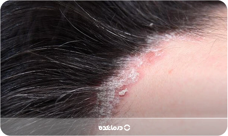 تصویر پسوریازیس سر را می‌بینید.