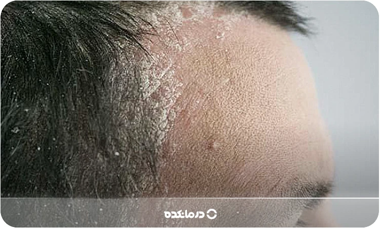 تصویر پسوریازیس پلاکی پوست سر را می‌بینید.