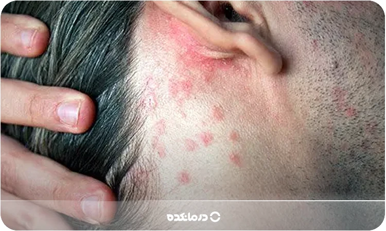 تصویر پسوریازیس نقطه‌ای یا قطره‌ای را می‌بینید.
