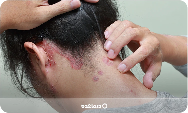 تصویر پسوریازیس معکوس را می‌بینید.
