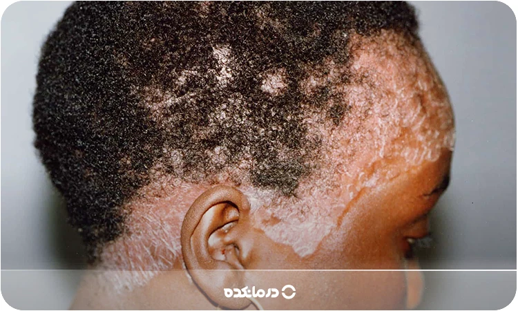 تصویر پسوریازیس اریترودرمی را می‌بینید
