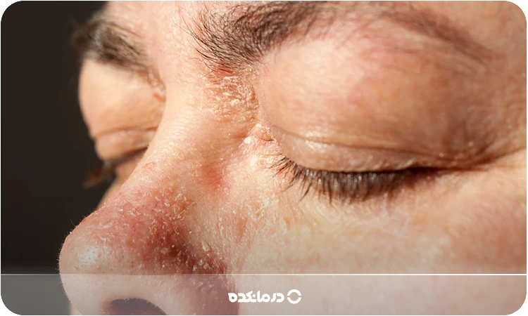 تصویر سبوپسوریازیس را می‌بینید.
