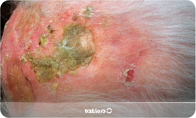 تصویر پسوریازیس چرکی را می‌بینید.
