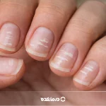 لکه سفید روی ناخن یا لوکونیشیا [۸ علت + پیشگیری و درمان]