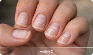 لکه سفید روی ناخن یا لوکونیشیا [۸ علت + پیشگیری و درمان]