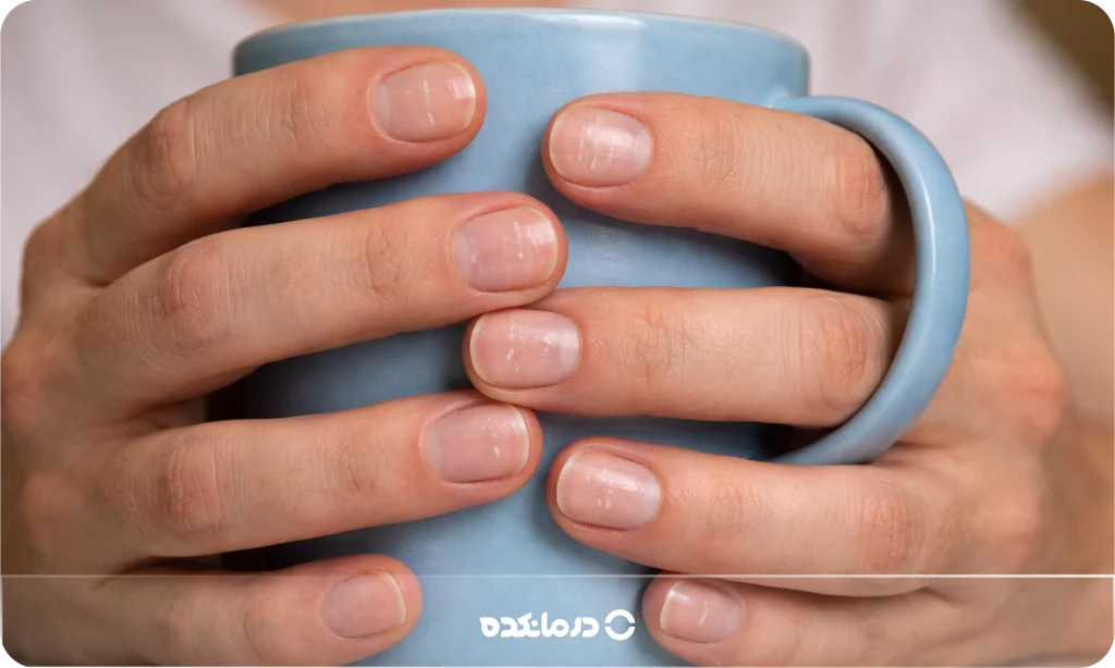تصویر لکه‌های سفید روی ناخن دست را می بینید