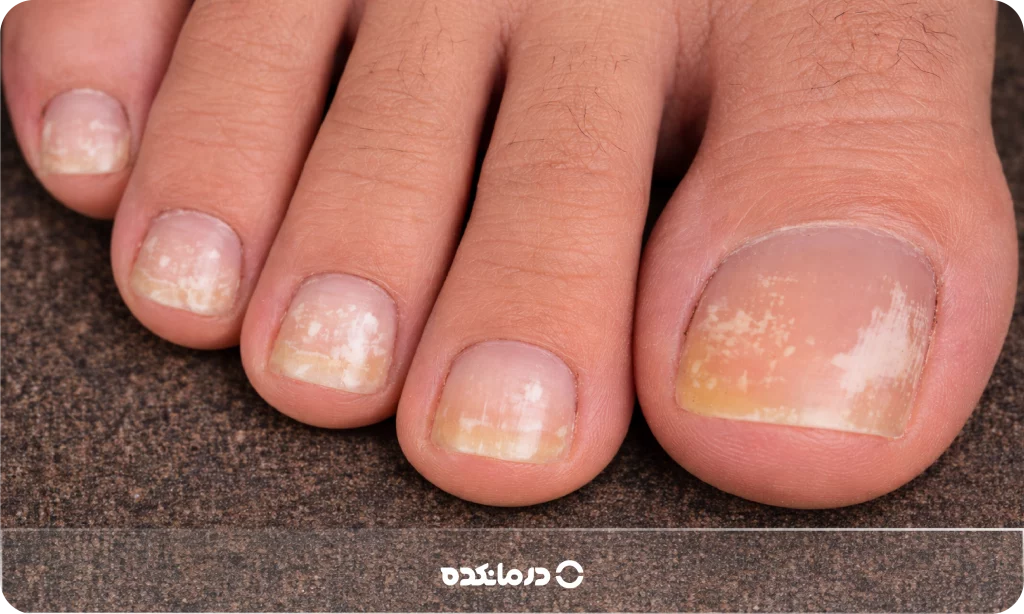 تصویر لکه‌های سفید روی ناخن پا را می بینید