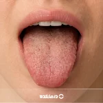 چه بیماری هایی باعث خشکی دهان میشود؟ ۱۹ بیماری مهم