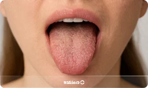 چه بیماری هایی باعث خشکی دهان میشود؟ ۱۹ بیماری مهم