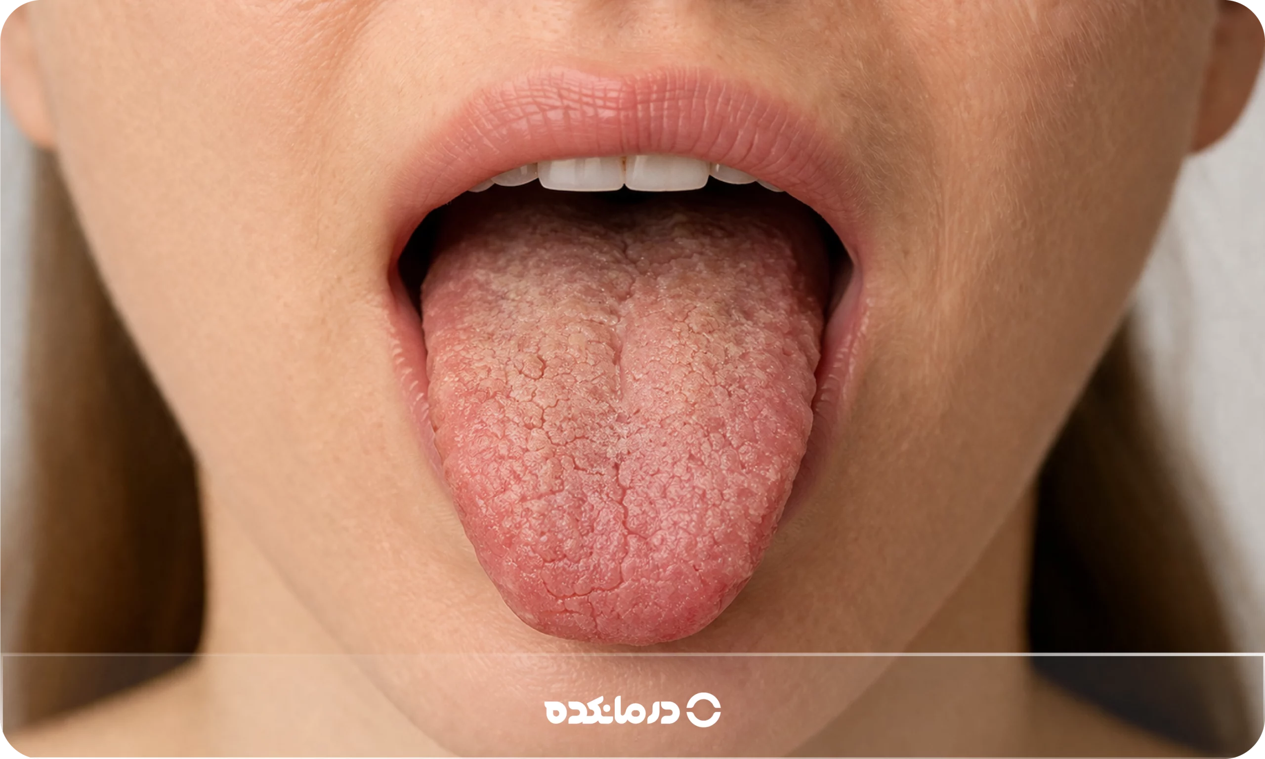 چه بیماری هایی باعث خشکی دهان میشود؟ ۱۹ بیماری مهم