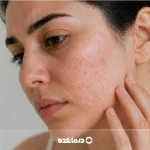 راش پوستی چیست؟ ۲۴ علت، انواع، روش درمان + بهترین پماد