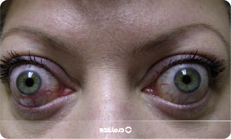 تصویری از بیرون زدگی چشم از حدقه را می بینید