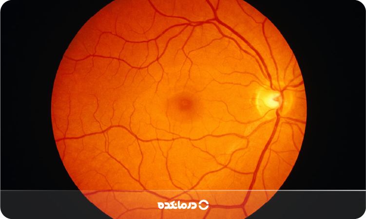 عکس شبکیه چشم سالم را می بینید