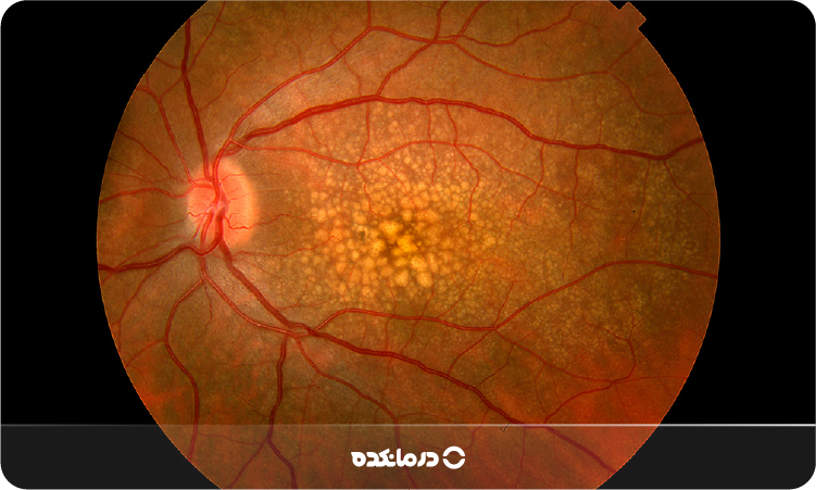 عکس شبکیه چشم ناسالم را می بینید