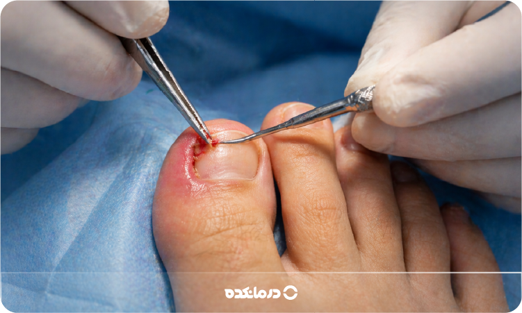 تصویری از جراحی ناخن فرو رفته در گوشت