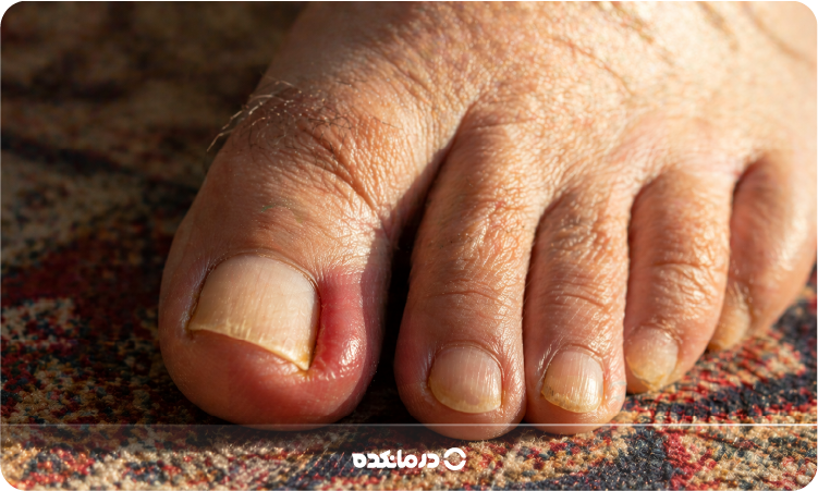 تصویری از ناخن فرو رفته در گوشت پا