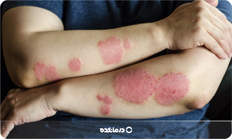 عکس اگزما سکه ای یا اگزمای دیسکوئید را می بینید
