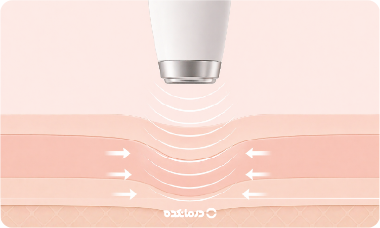 تصویر گرافیکی از لابیاپلاستی با دستگاه RF را می بینید