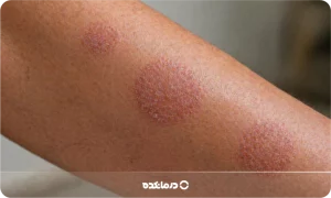 اگزمای دیسکوئید (سکه ای) چیست؟ علت، علائم + درمان قطعی