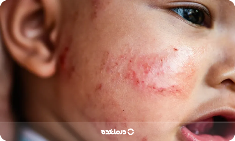 تصویر اگزمای سکه ای روی بدن نوزاد را می بینید