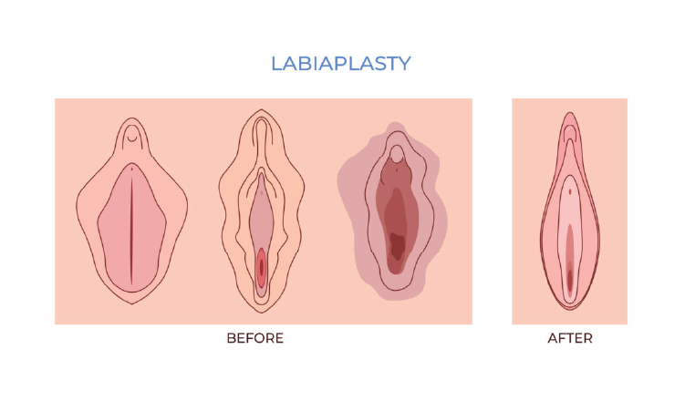 تصویر گرافیکی از ایجاد برش و بخیه زدن لابیاپلاستی را می بینید