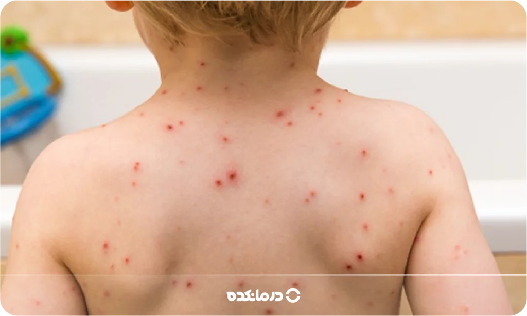 تصویر آبله‌مرغان را می بینید