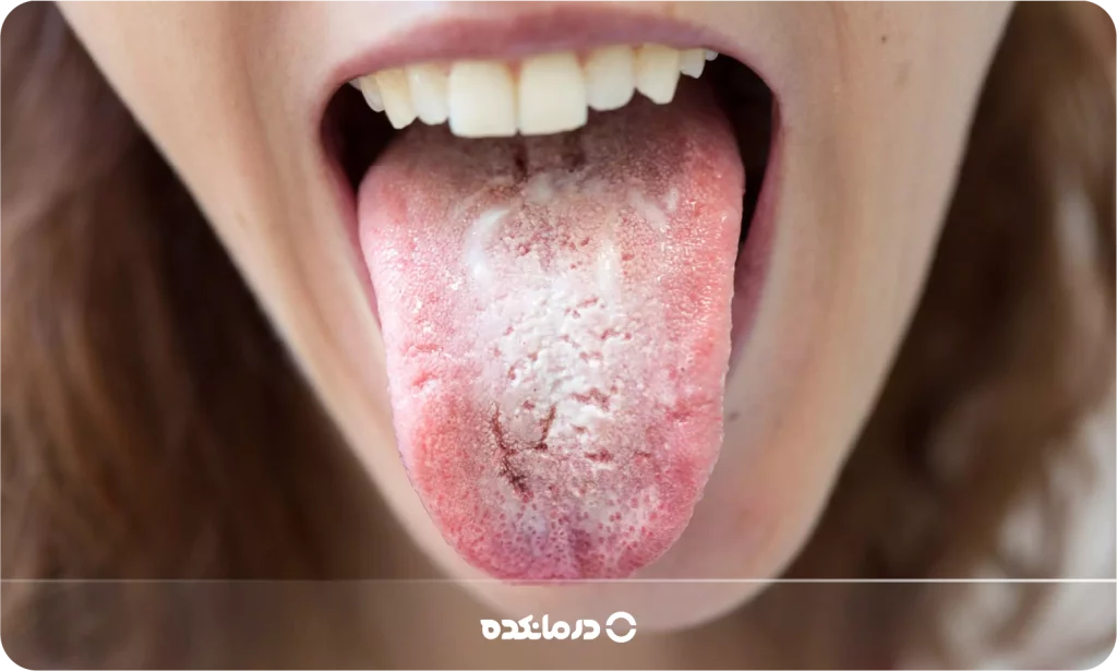 تصویر عفونت قارچی کاندیدا را می بینید