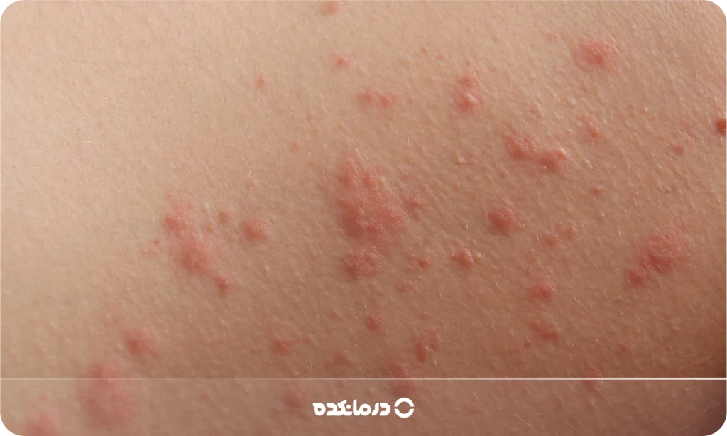 تصویر درماتیت تماسی را می بینید